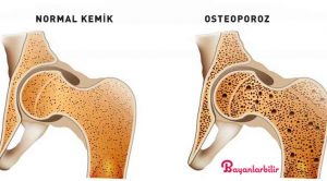 Kemik Yoğunluğunu Artırmanın ve Sağlıklı Kemiklere sahip olmanın Yolu (Osteoporoz Diyeti Dahil)