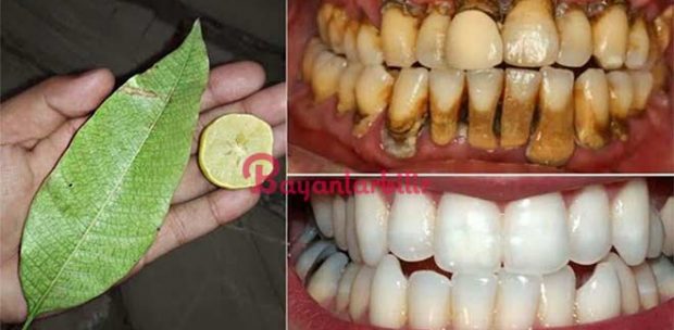 Doğal yollarla Karbonat limon karışımı diş beyazlatma yöntemi