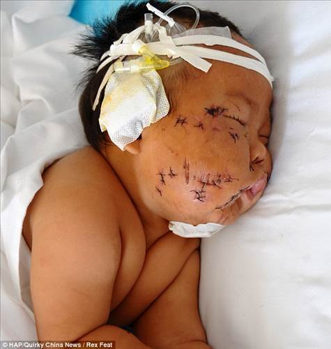 Çin’de bir hemşire (Malesef sağlık personeli) 8 aylık bebeği tarafından emzirirken memesini ısırdığı gerekçesiyle makas ile 90 yerinde kesikler attı. Haberin diğer fotoğrafları için görsele tıklayın
