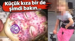 Doğum lekeli kızın yeni hali