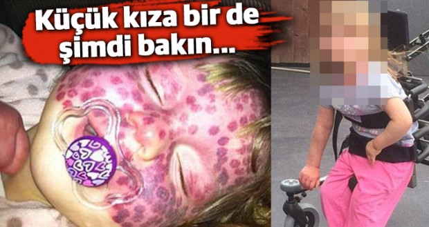 Doğuştan yüzündeki bu lekelerle doğan 5 yaşındaki
