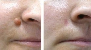 Fibrom nedir ve fibrom doğal tedavi yöntemi