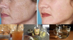 Doğal yolla Cilt lekeleri nasıl yok edilir