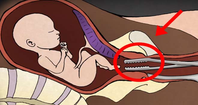 Kürtaj sırasında bebeğinize ne olur ?