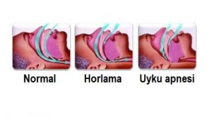 Horlamayı Doğal yollarla Durdurmak