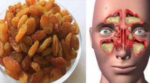 Zencefil üzüm ile sinüzit tedavisi