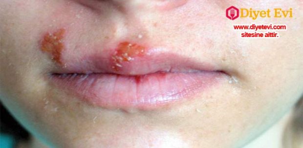 Uçukların sebebi herpes simplex virüsüdür, bu virüs oldukça bulaşıcıdır ve aktif uçuğa dokunmayla kolayca yayılabilir. Bu virüs küçük ve acı veren su toplamalarına yol açar, bunlara uçuk adı verilir. Görüntüsünün de kötü olmasının yanı sıra kişiden kişiye sadece temasla kolayca yayılabilir. Devam etmek için görsele tıklayın ve diğer fotoğrafa geçin