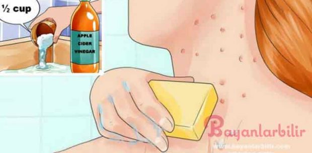 Elma sirkesi ile egzama tedavisi nasıl yapılır