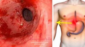 Gastrit ve mide yanması doğal tedavi yöntemi