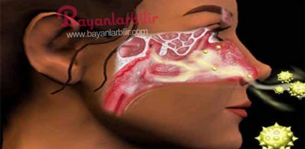 Sinüs nedir? Sinüzit nedir? Sinüs iltihaplanması nasıl olur? Belirtileri nelerdir, tedavisi hakkında bilgi: Organların ya da dokuların, özellikle de bazı kafa ve yüz kemiklerinin içindeki boşluğa sinüs adı verilir; sinüslerin iltihaplanmasıysa sinüzit diye adlandırılır. İnsanlar genellikle sinüzit tedavisi için antibiyotik kullanmayı tercih eder fakat bu tercih yan etkileri de beraberinde getirir. Mide bulantısı , ateş, bağırsak yapısının bozulması, yararlı bakterilerin vürüslerle beraber yok olması gibi… Size vereceğimiz tarif ile sinüzit, grip, geniz akıntısı, balgam gibi şikayetleriniz doğal olarak tedavi edilecektir. Tarif ve malzemeler için görsele tıklayın ve 2. fotoğrafa geçin.