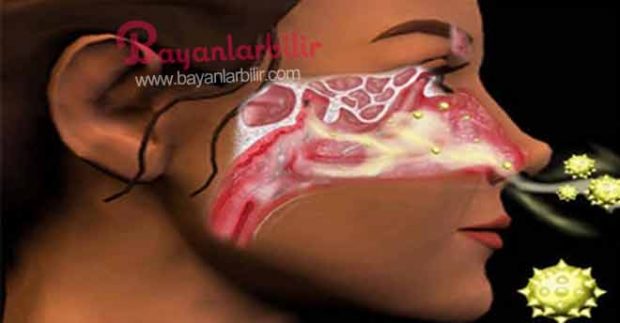 Sinüs nedir? Sinüzit nedir? Sinüs iltihaplanması nasıl olur? Belirtileri nelerdir, tedavisi hakkında bilgi: Organların ya da dokuların, özellikle de bazı kafa ve yüz kemiklerinin içindeki boşluğa sinüs adı verilir; sinüslerin iltihaplanmasıysa sinüzit diye adlandırılır. İnsanlar genellikle sinüzit tedavisi için antibiyotik kullanmayı tercih eder fakat bu tercih yan etkileri de beraberinde getirir. Mide bulantısı , ateş, bağırsak yapısının bozulması, yararlı bakterilerin vürüslerle beraber yok olması gibi… Size vereceğimiz tarif ile sinüzit, grip, geniz akıntısı, balgam gibi şikayetleriniz doğal olarak tedavi edilecektir. Tarif ve malzemeler için görsele tıklayın ve 2. fotoğrafa geçin.