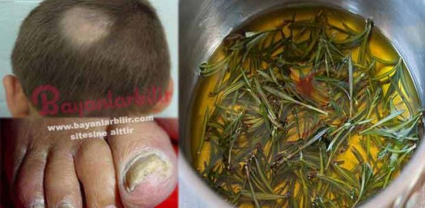 Sarımsak biberiye ile Mantar tedavisi nasıl yapılır