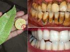 Doğal yollarla Karbonat limon karışımı diş beyazlatma yöntemi